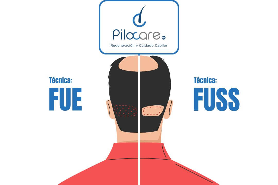 ¿Técnica FUE o Técnica FUSS?
