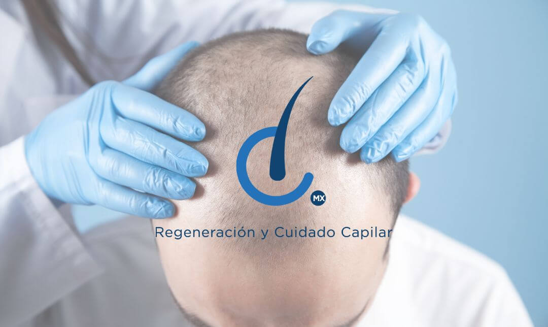 Técnica FUE: Lo esencial que debes conocer