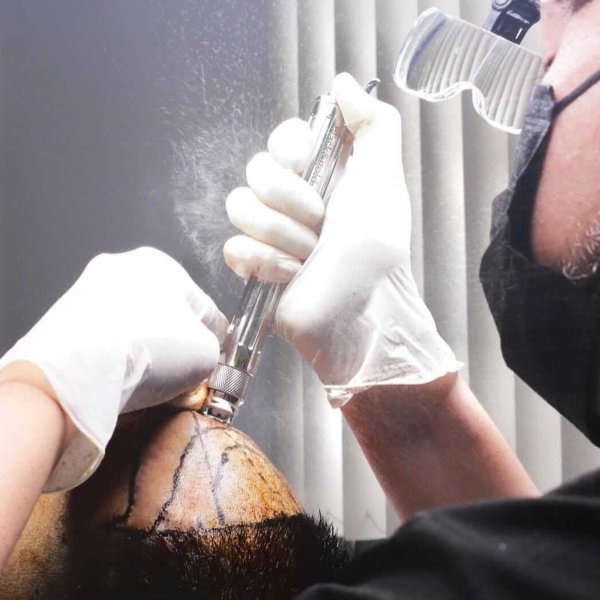 Anestesia sin Aguja PILOCARE